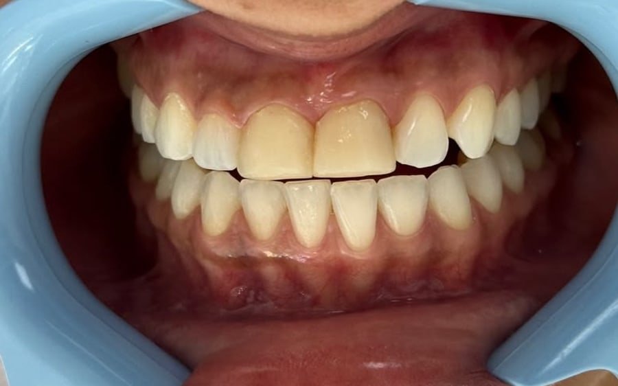 Antes: dentes superiores com os dois incisivos centrais mais escuros e curtos