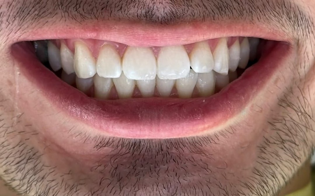 Depois: o mesmo sorriso com os dentes mais claros