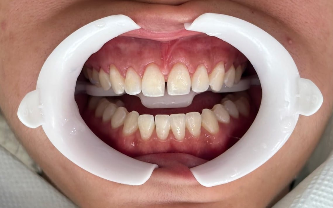 Depois: os mesmos dentes, mais claros